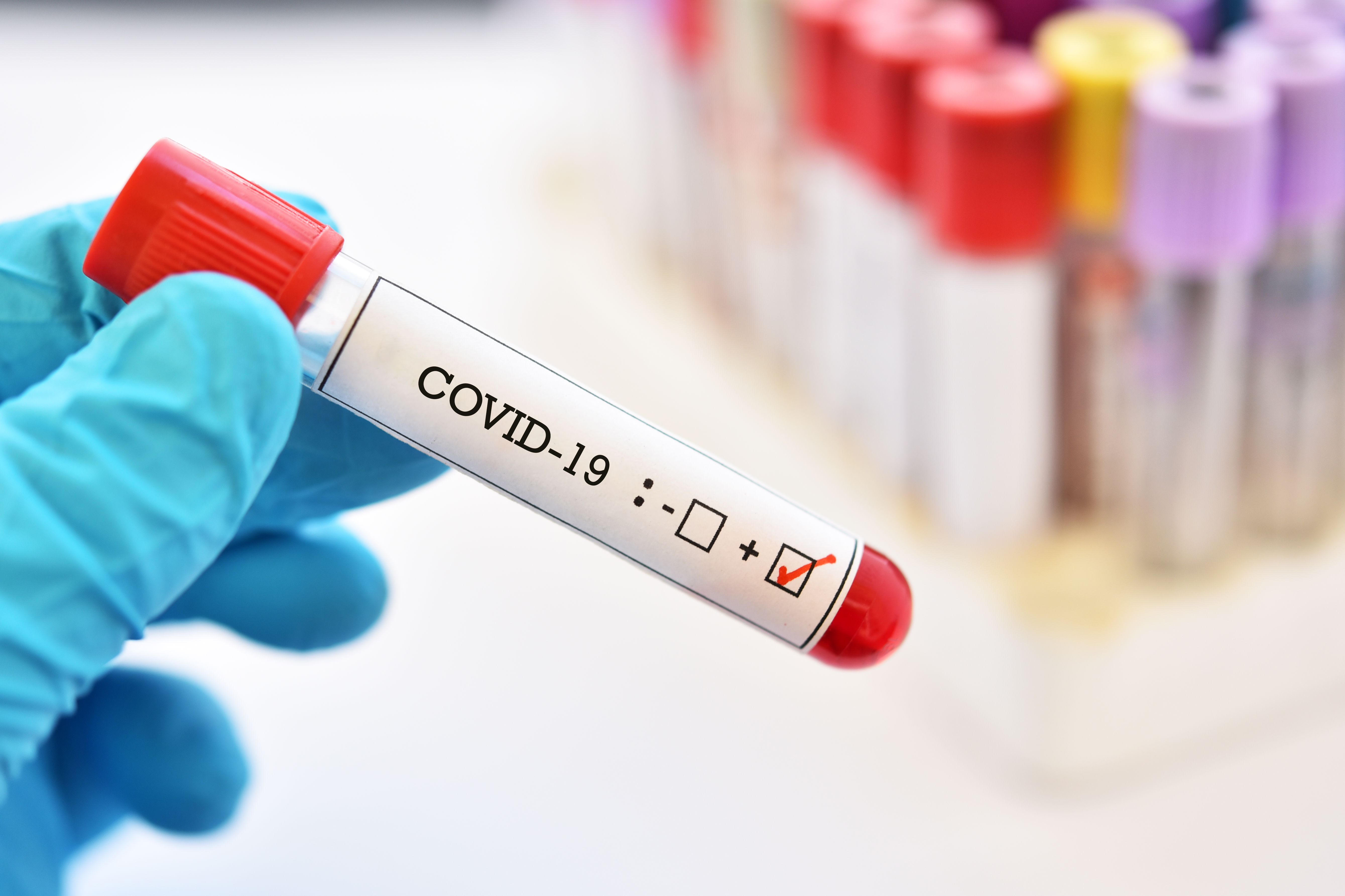 Imagem de recipiente contendo sangue identificado como covid-19